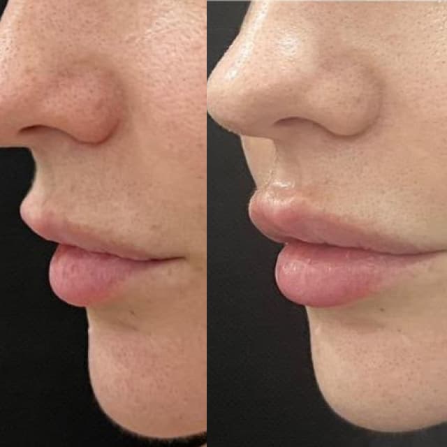 Filler Bibir