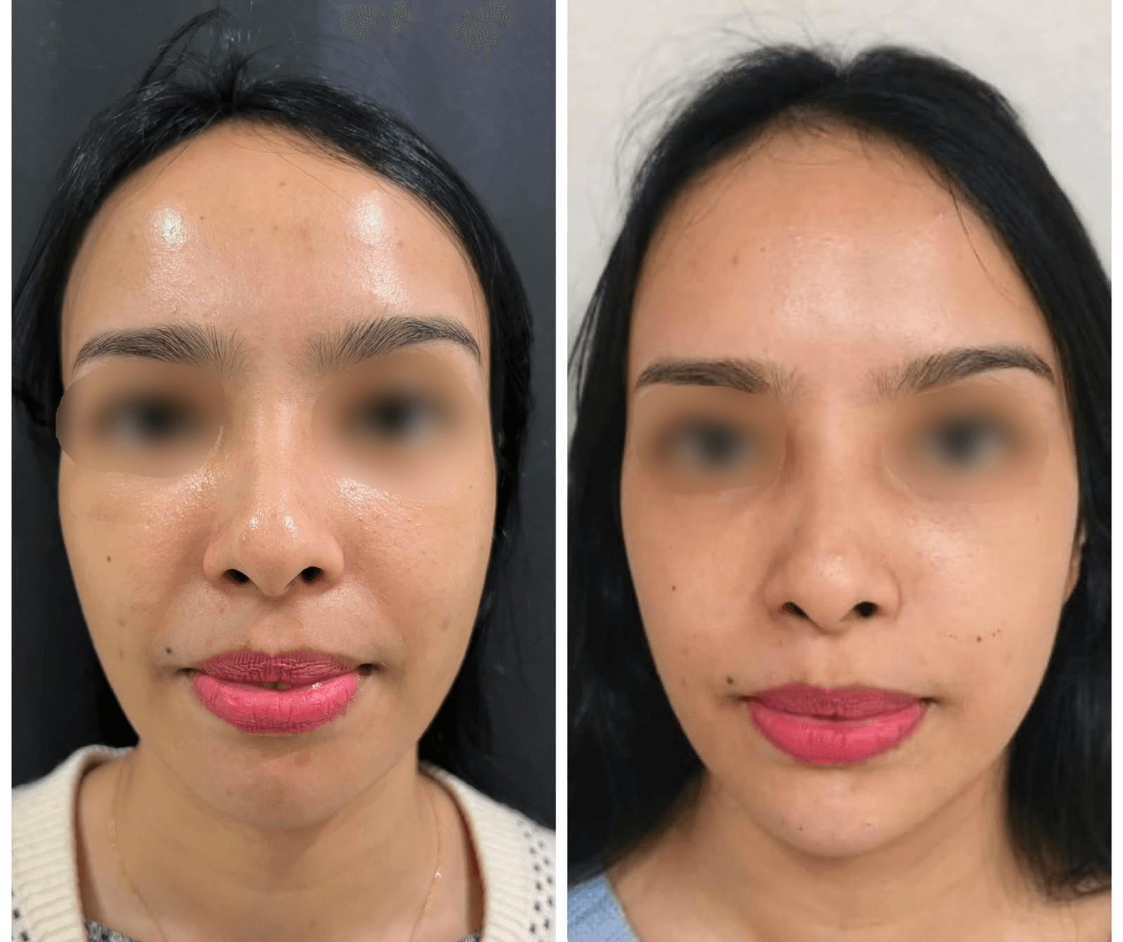 Filler Dagu