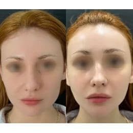 Hasil HIFU Full Face Privá Med